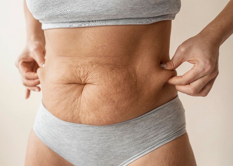 Excesso de pele após emagrecimento: por que acontece e quando a cirurgia deixa de ser estética para virar necessidade Excesso de pele após emagrecimento: por que acontece e quando a cirurgia deixa de ser estética para virar necessidade
